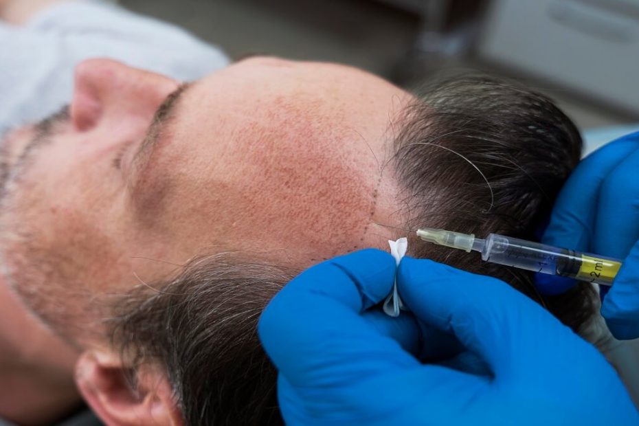 5 Key Benefits of Follicular Unit Extraction for Hair Restoration