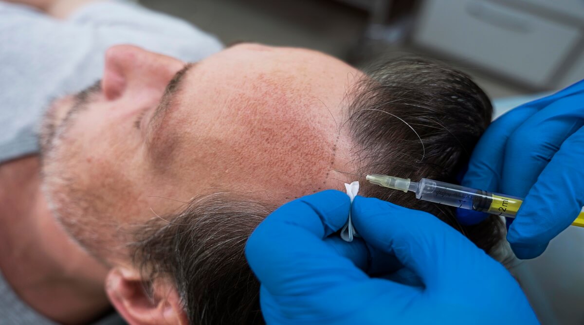 5-key-benefits-of-follicular-unit-extraction-for-hair-restoration